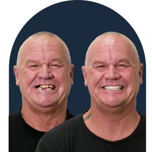 Dental Implants Patients Before and After
